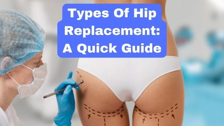 Types of Hip Replacement: A Quick Guide